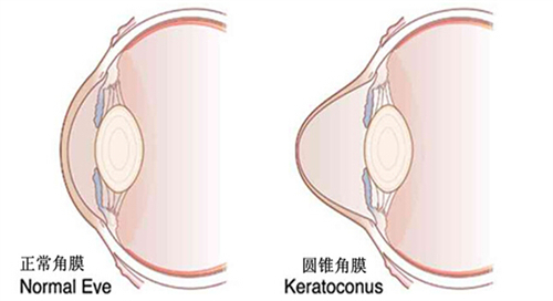 角膜不规律也可能会导致圆锥角膜
