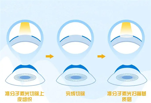 准分子激光手术过程