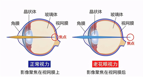 老花眼和正常视力