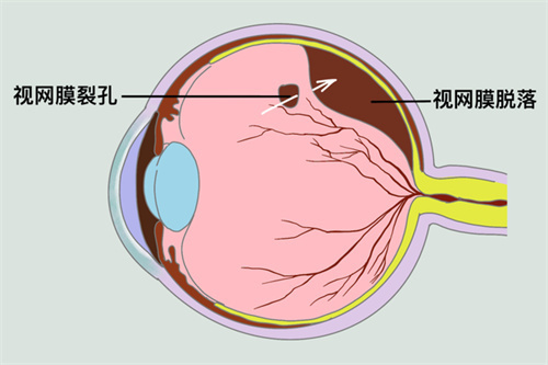 视网膜脱落