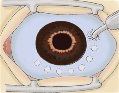 睫状体冷冻术手术过程图解