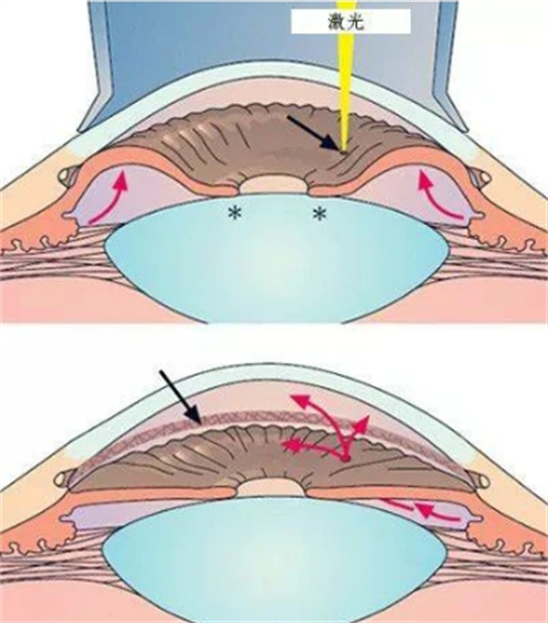 周边虹膜切除术步骤图解