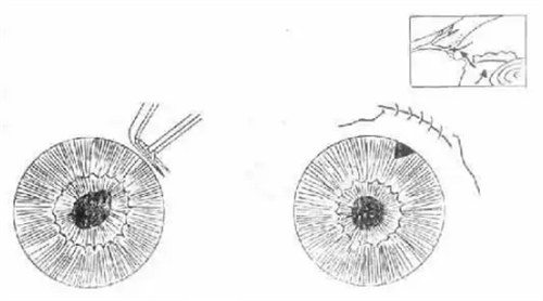 周边虹膜切除术手术过程图解