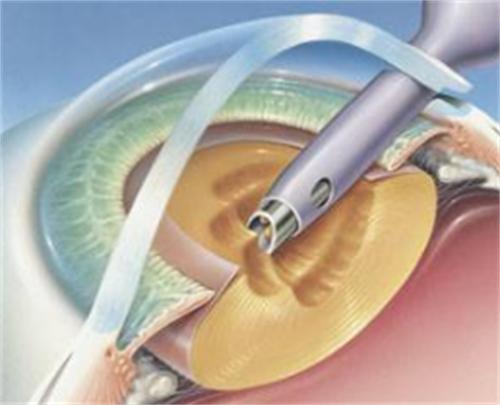 周边虹膜切除术手术过程图片