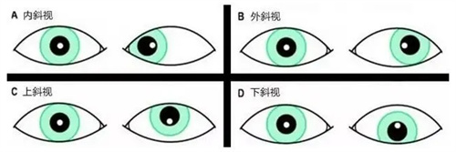 斜视的四种情况