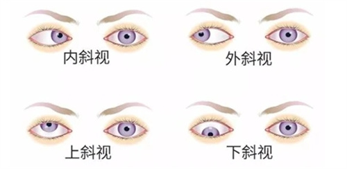 四种斜视动画图