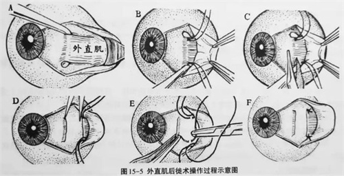 斜视手术流程图