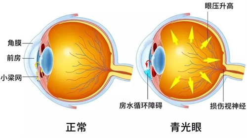 正常眼和青光眼结构对比图