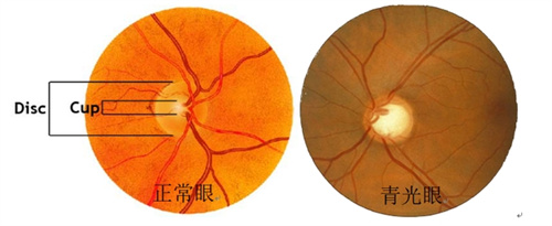 正常眼和青光眼对比图