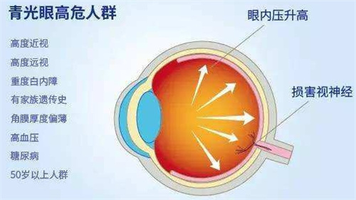 青光眼高危人群展示图