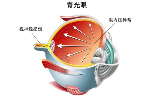 70岁老人青光眼有必要手术吗?可药物治疗也可手术具体需详检!