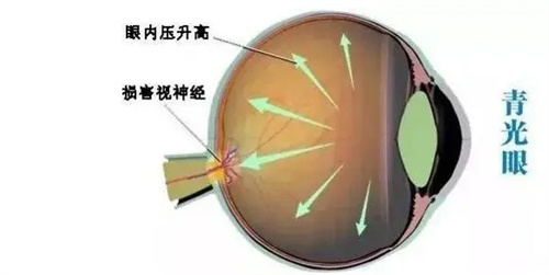 眼内压升高图