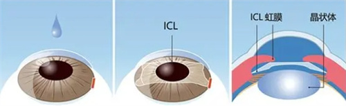 icl人工晶体动画图