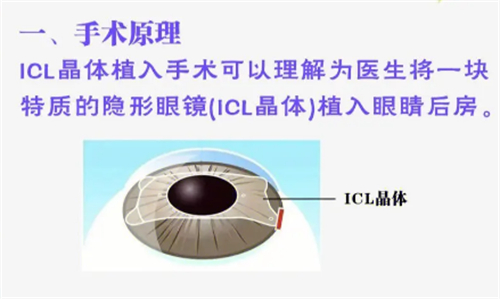 ticl晶体植入手术原理图解