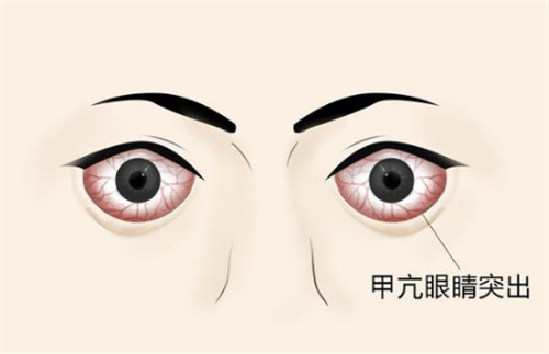 甲亢突眼的样子图片