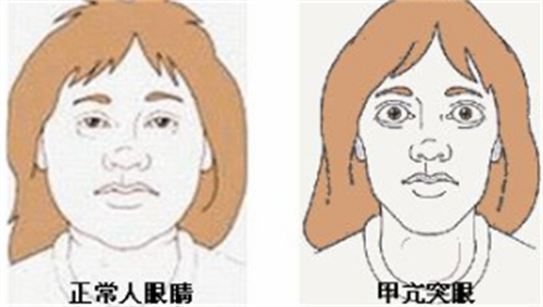 甲亢突眼和正常眼球的区别