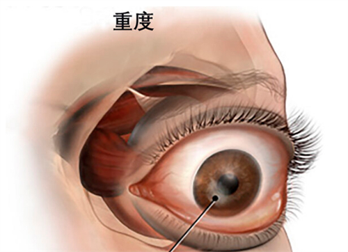 甲亢突眼眼球的表现图解