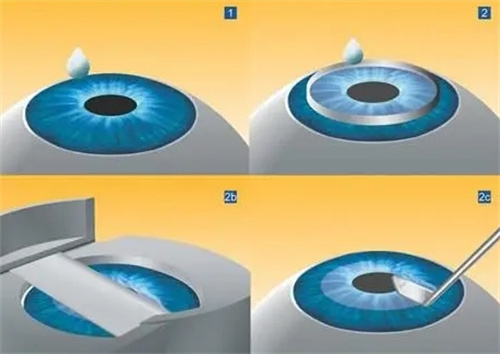 近视手术流程演示图