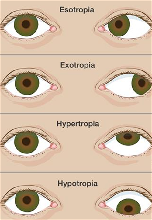 不同程度的斜视眼睛