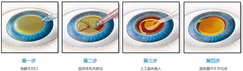 白内障手术流程图