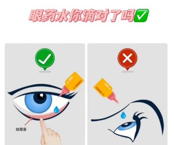 正确滴眼药水的方法图解