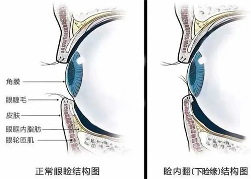 倒睫给眼球带来的伤害图解