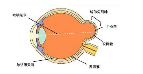 后巩膜加固术动画图