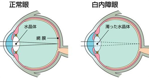 正常眼和白内障眼对比图