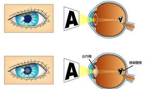 正常眼成像和白内障成像对比图