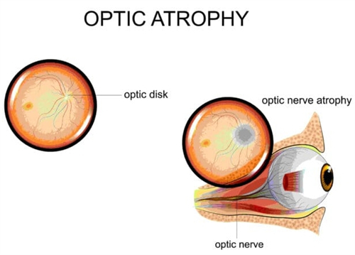 视神经萎缩有救了!!!文内分享视神经萎缩怎么治疗如何恢复视力,点击查看