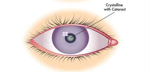 白内障发病晶体展示图