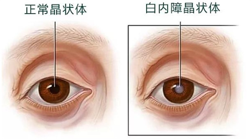 正常眼睛和白内障眼睛对比图