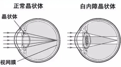 正常晶体和白内障晶体对比