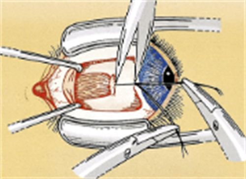 斜视手术操作过程图图解