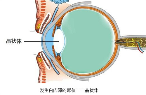 白内障晶状体展示图