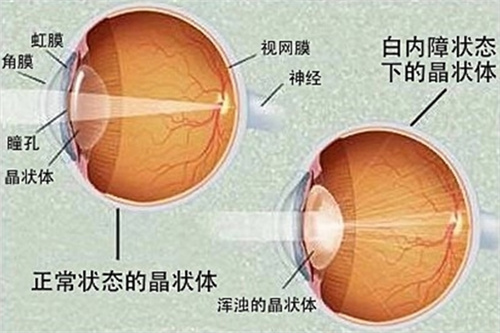 白内障状态下的晶体展示图