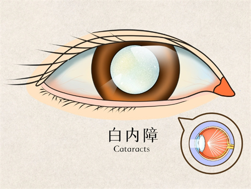 ​白内障手术后视力更差了怎么回事，可能有后发性白内障/人工晶状体位置异常/眼底病变等情况！