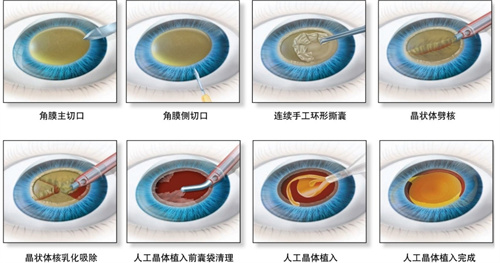 白内障手术流程图