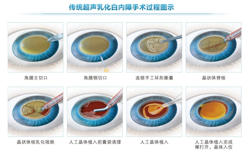 白内障手术流程图