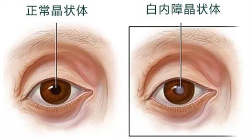 正常晶体和白内障晶体对比