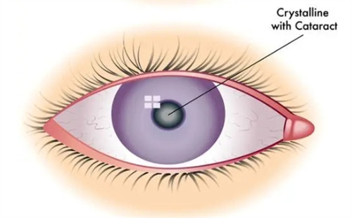 白内障病变晶体图