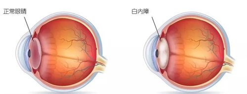 正常眼睛和白内障对比图