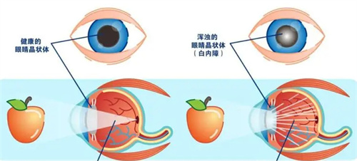 白内障视光图