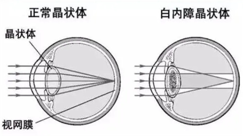 正常晶状体和白内障晶状体对比