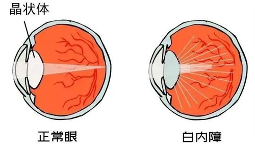 正常晶状体和白内障晶状体对比