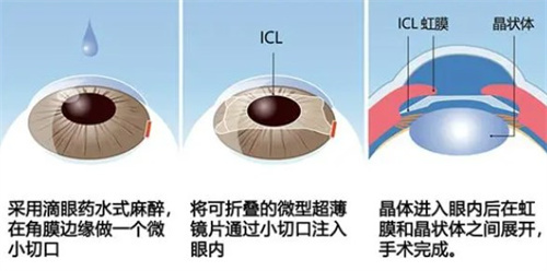 ICL手术过程