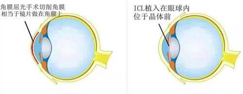 ICL植入和屈光手术