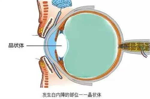 白内障晶状体动画图