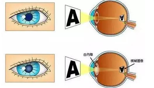 白内障视光图