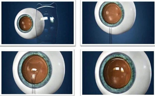 晶体植入术过程展示图